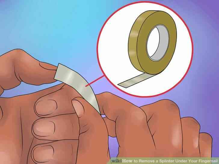 Image intitulée Enlever une Écharde Sous Ton Ongle Étape 7